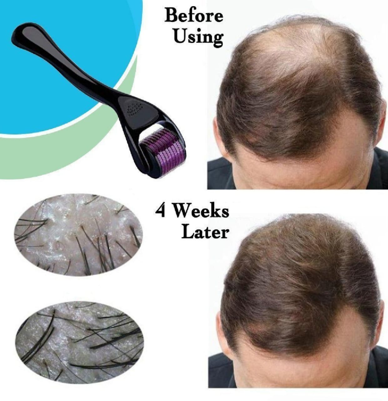 Derma Roller For Hair And Skin 0.5 Mm Hair & Skin Care Derma Roller